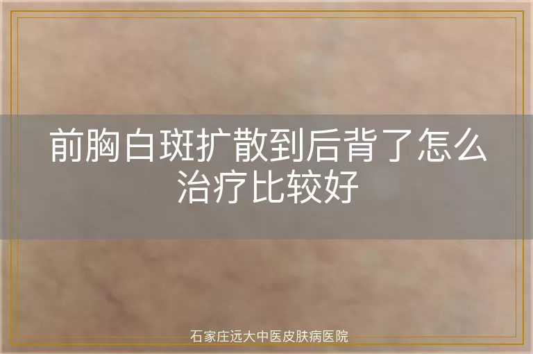 前胸白斑扩散到后背了怎么治疗比较好
