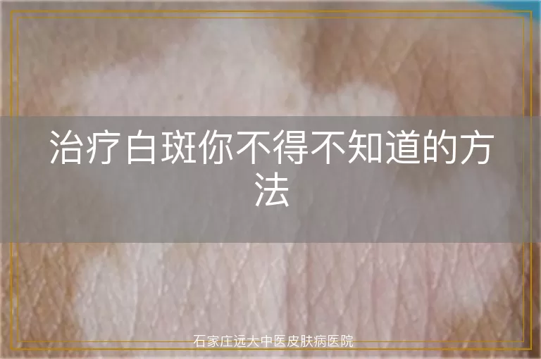 治疗白斑你不得不知道的方法