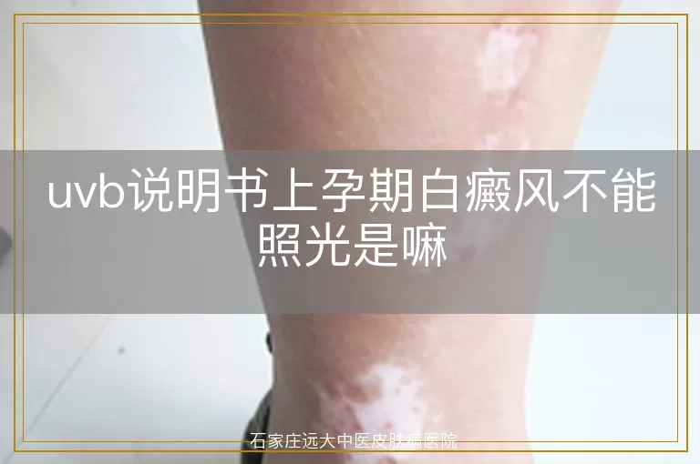 uvb说明书上孕期白癜风不能照光是嘛
