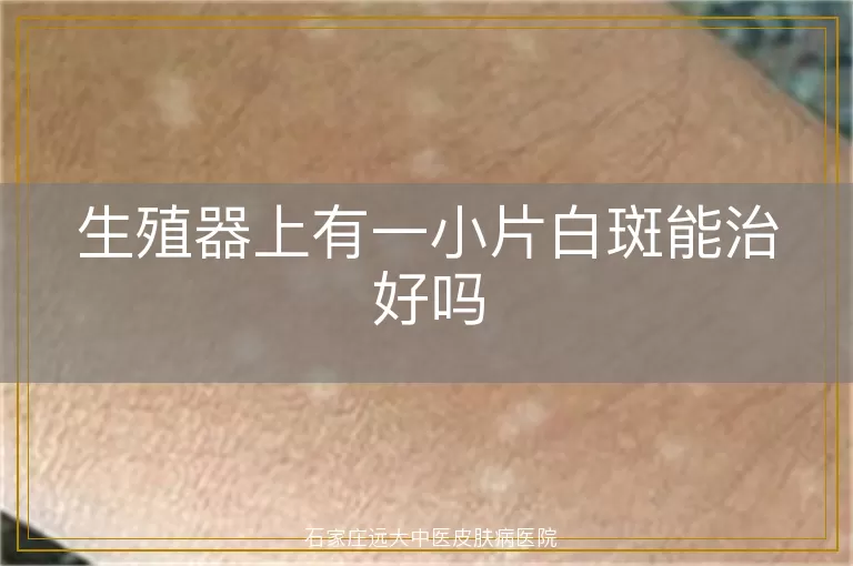生殖器上有一小片白斑能治好吗