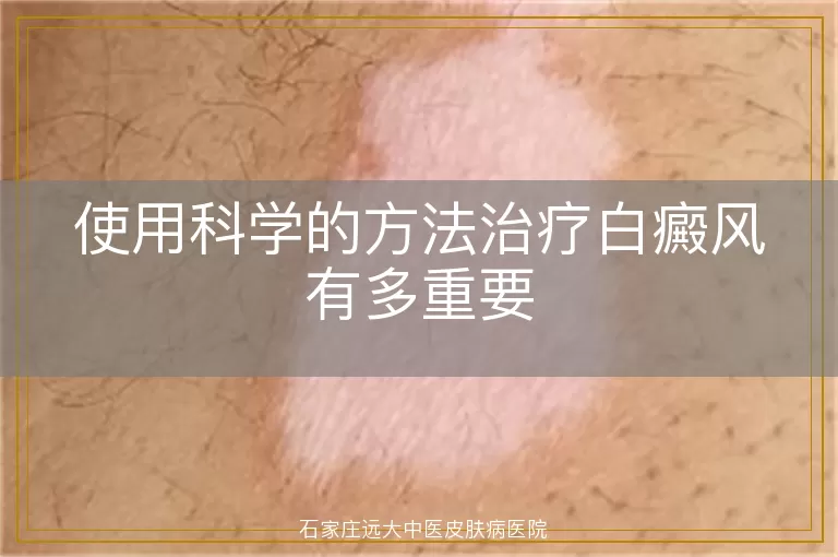 使用科学的方法治疗白癜风有多重要