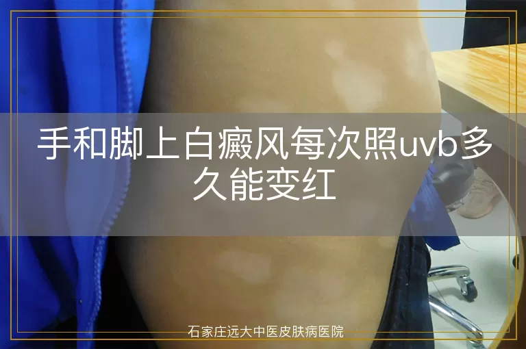 手和脚上白癜风每次照uvb多久能变红