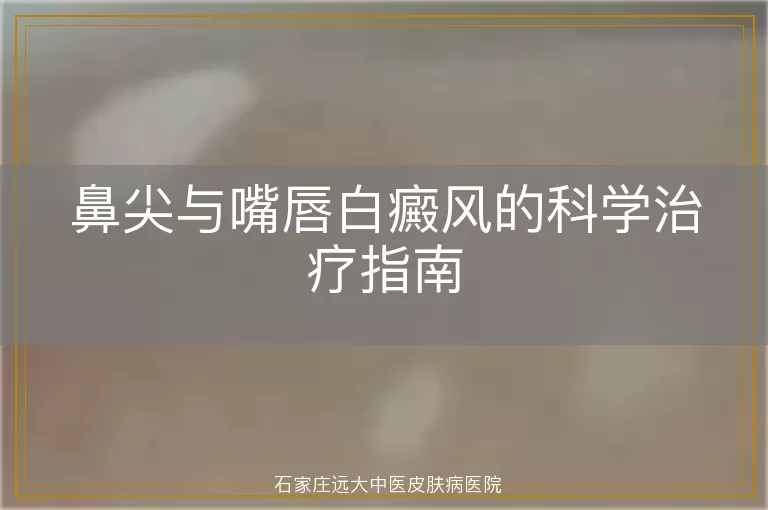 鼻尖与嘴唇白癜风的科学治疗指南