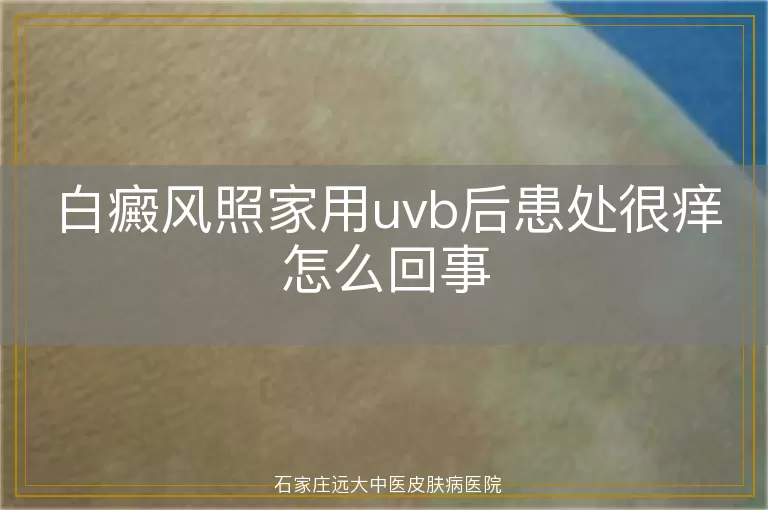 白癜风照家用uvb后患处很痒怎么回事