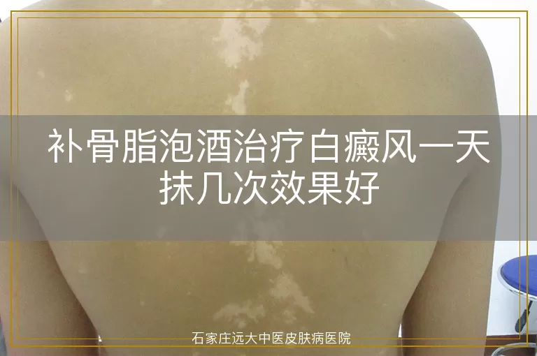 补骨脂泡酒治疗白癜风一天抹几次效果好