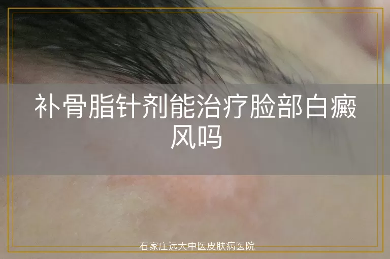 补骨脂针剂能治疗脸部白癜风吗