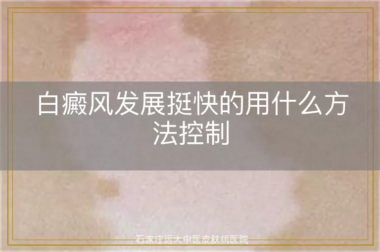 白癜风发展挺快的用什么方法控制