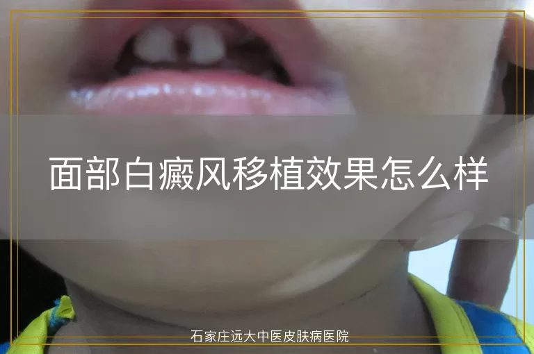 面部白癜风移植效果怎么样