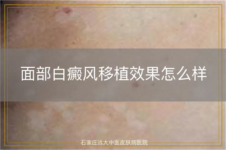 面部白癜风移植效果怎么样
