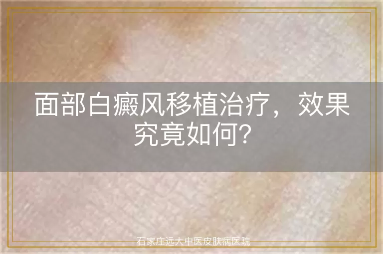 面部白癜风移植治疗，效果究竟如何？