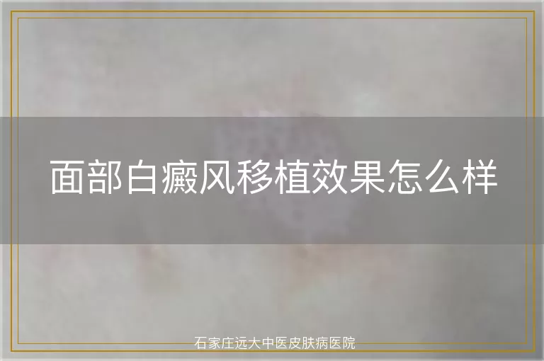 面部白癜风移植效果怎么样