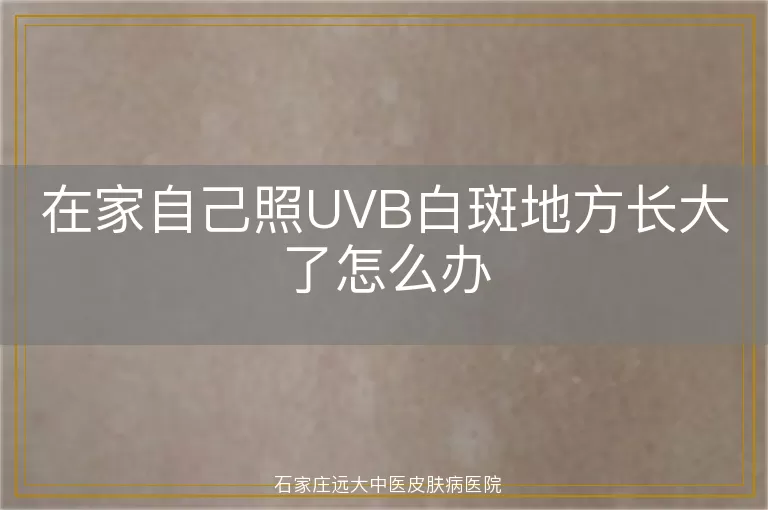 在家自己照UVB白斑地方长大了怎么办