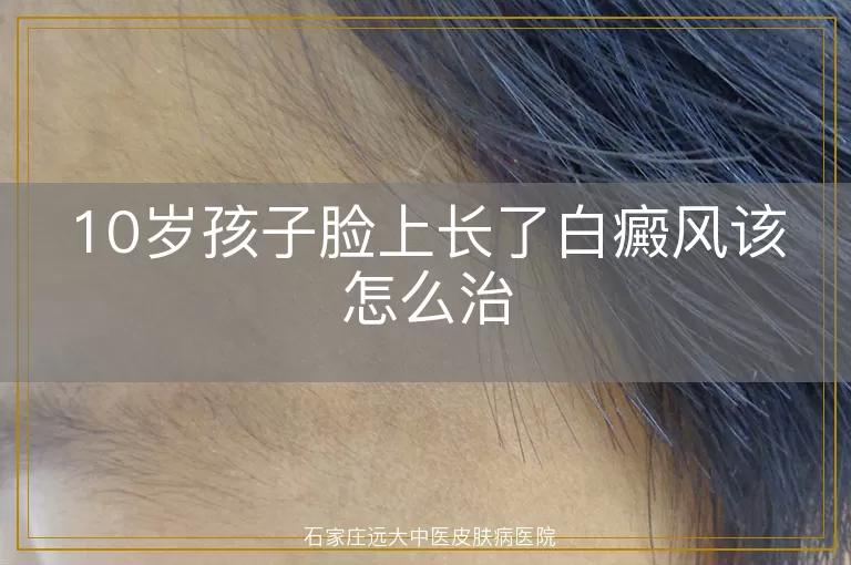 10岁孩子脸上长了白癜风该怎么治