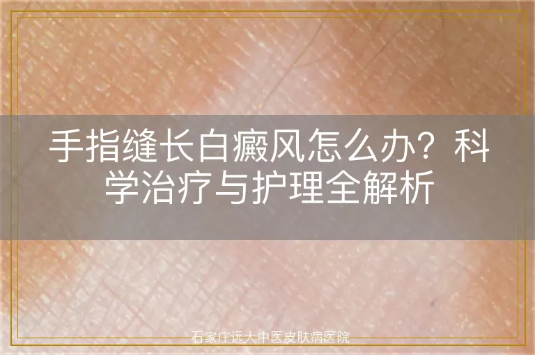 手指缝长白癜风怎么办?科学治疗与护理全解析