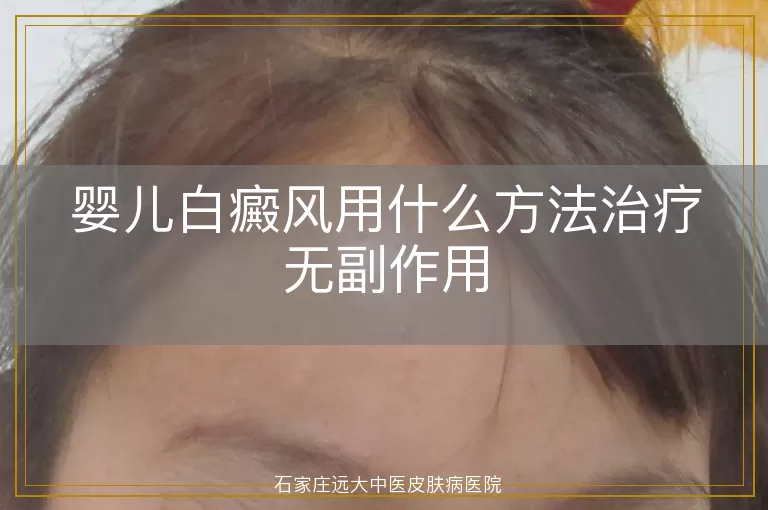 婴儿白癜风用什么方法治疗无副作用