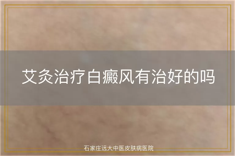 艾灸治疗白癜风有治好的吗