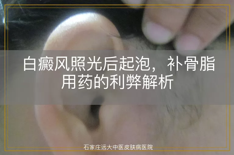 白癜风照光后起泡，补骨脂用药的利弊解析