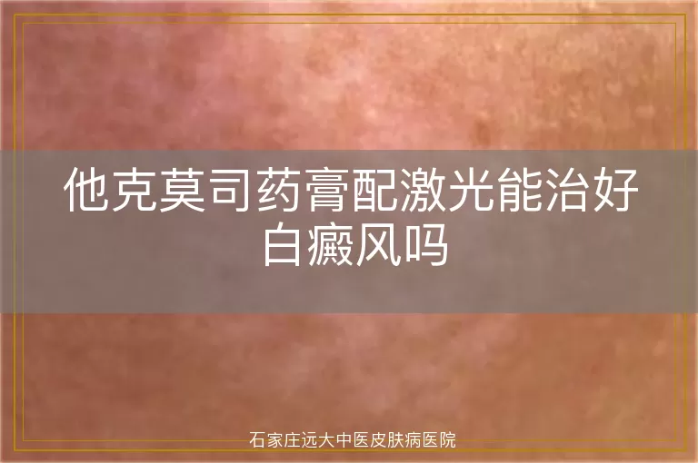 他克莫司药膏配激光能治好白癜风吗