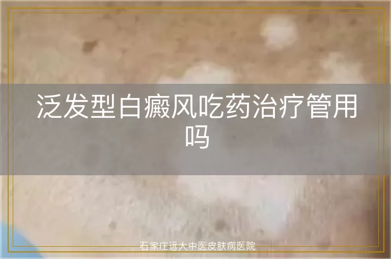 泛发型白癜风吃药治疗管用吗