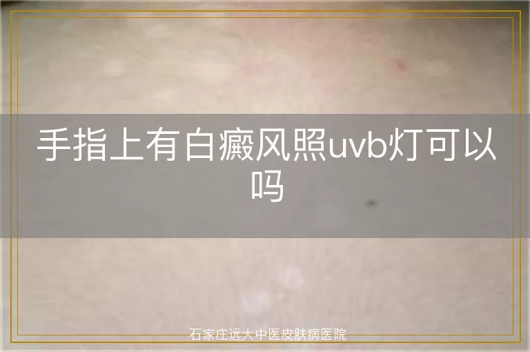 手指上有白癜风照uvb灯可以吗