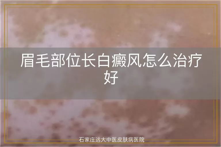 眉毛部位长白癜风怎么治疗好
