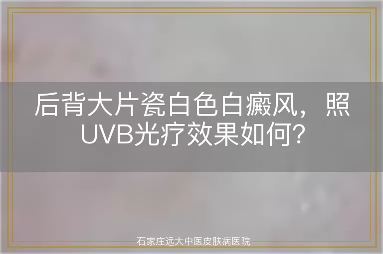 后背大片瓷白色白癜风，照UVB光疗效果如何？