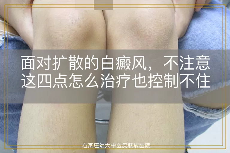 面对扩散的白癜风，不注意这四点怎么治疗也控制不住