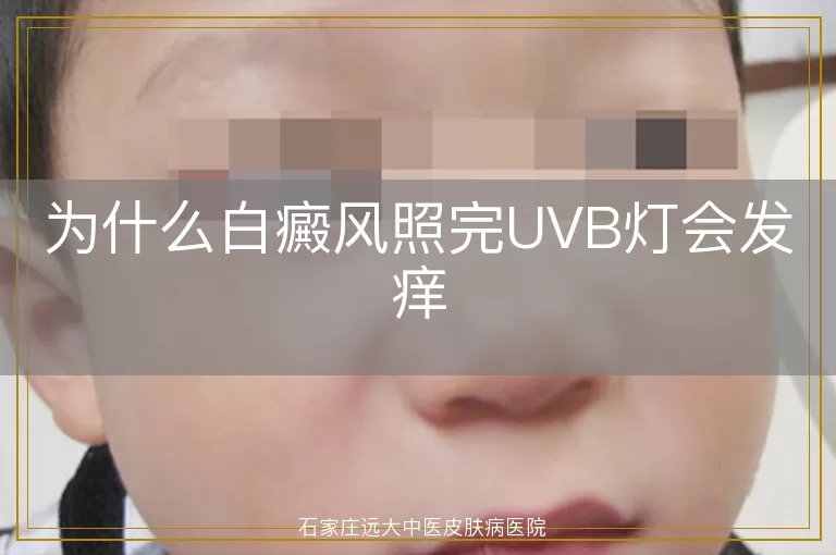 为什么白癜风照完UVB灯会发痒