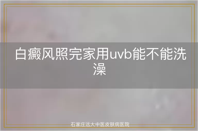 白癜风照完家用uvb能不能洗澡