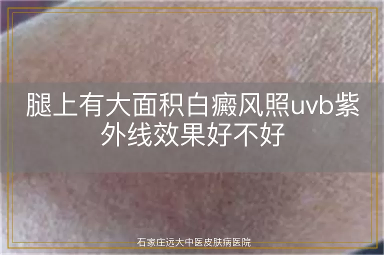 腿上有大面积白癜风照uvb紫外线效果好不好