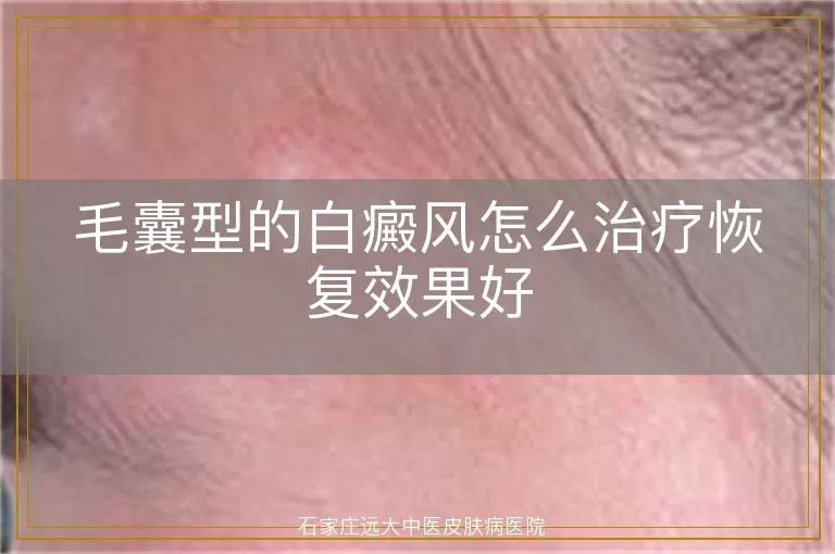 毛囊型的白癜风怎么治疗恢复效果好