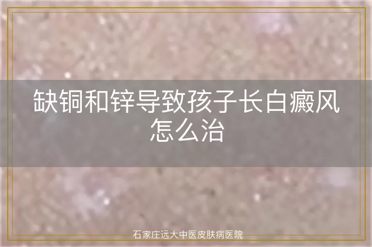 缺铜和锌导致孩子长白癜风怎么治