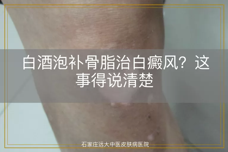 白酒泡补骨脂治白癜风？这事得说清楚