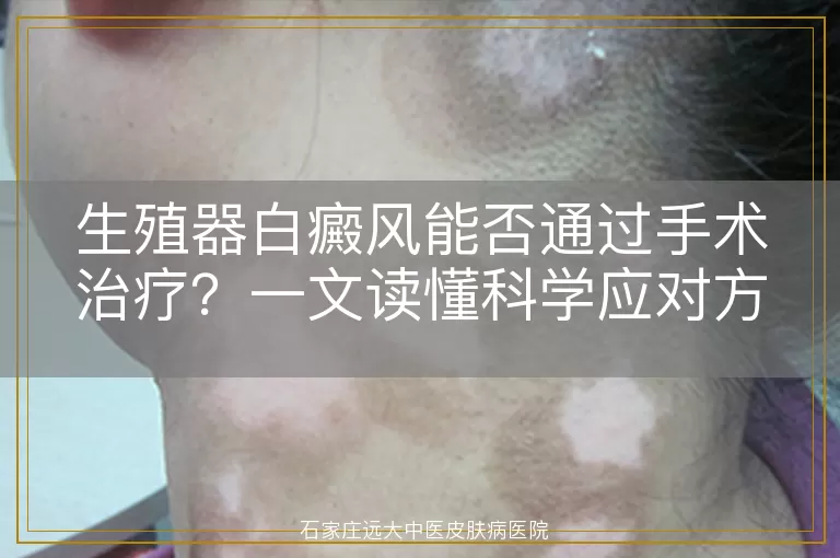生殖器白癜风能否通过手术治疗？一文读懂科学应对方案