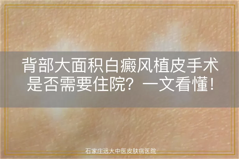 背部大面积白癜风植皮手术是否需要住院？一文看懂！