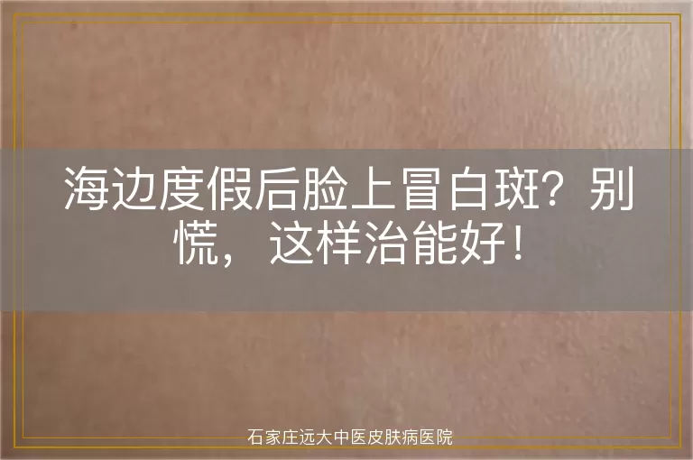 海边度假后脸上冒白斑？别慌，这样治能好！