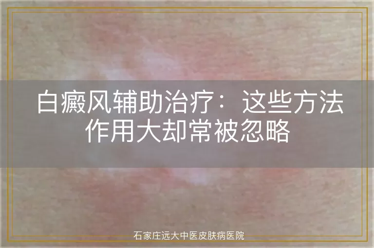 白癜风辅助治疗：这些方法作用大却常被忽略