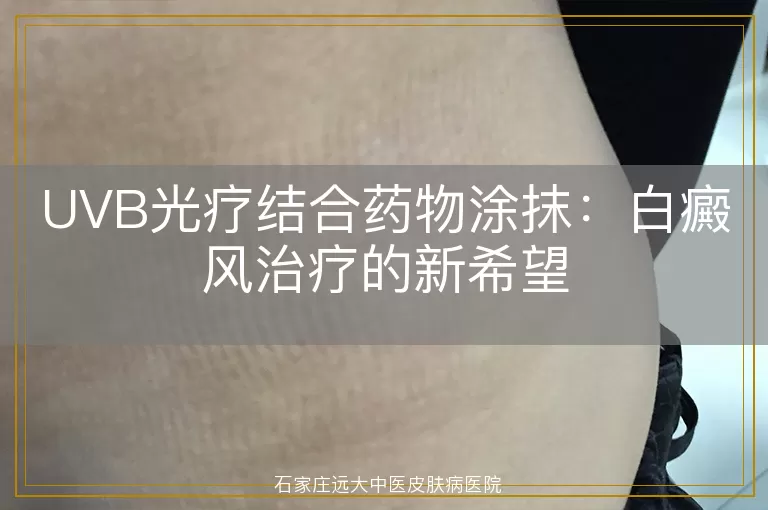 UVB光疗结合药物涂抹：白癜风治疗的新希望
