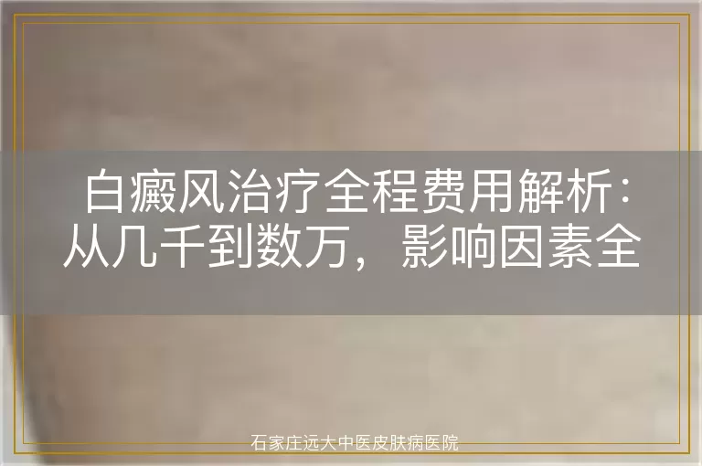 白癜风治疗全程费用解析：从几千到数万，影响因素全知道