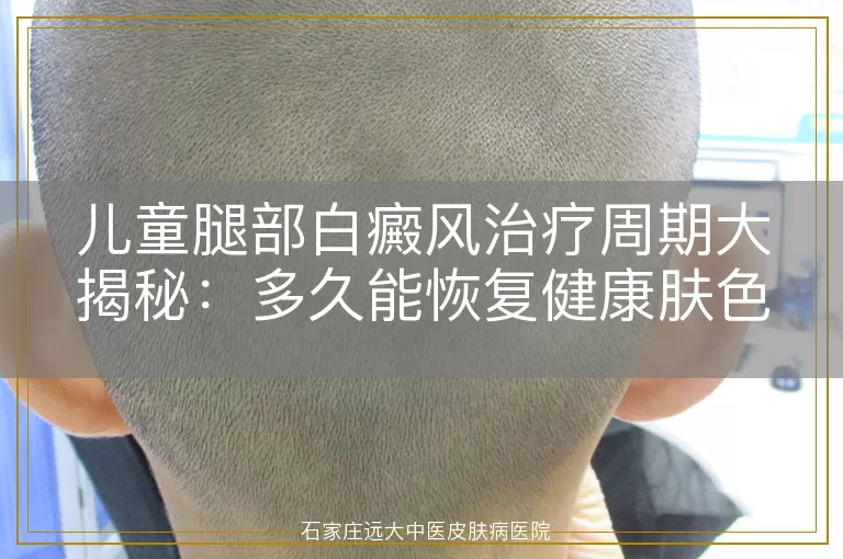 儿童腿部白癜风治疗周期大揭秘：多久能恢复健康肤色？