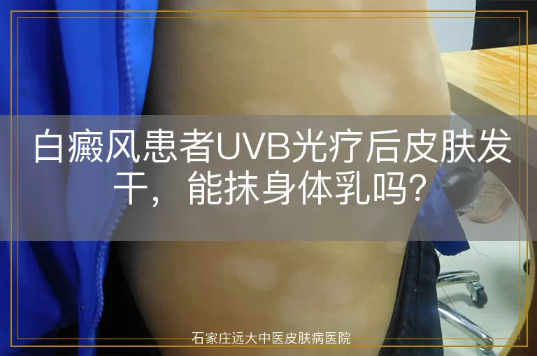 白癜风患者UVB光疗后皮肤发干，能抹身体乳吗？