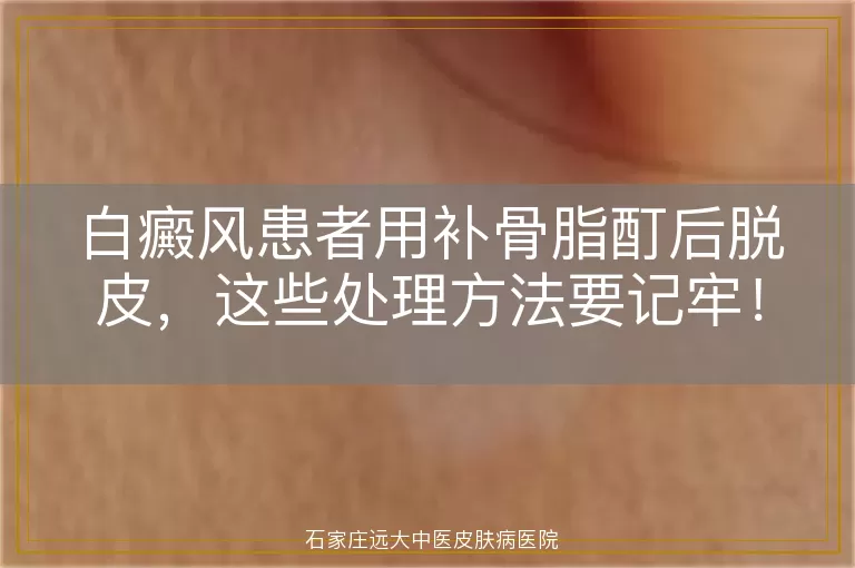 白癜风患者用补骨脂酊后脱皮，这些处理方法要记牢！