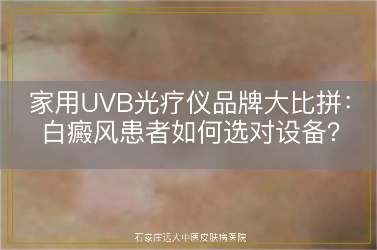 家用UVB光疗仪品牌大比拼：白癜风患者如何选对设备？