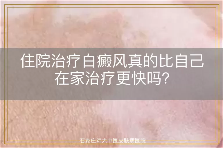 住院治疗白癜风真的比自己在家治疗更快吗？