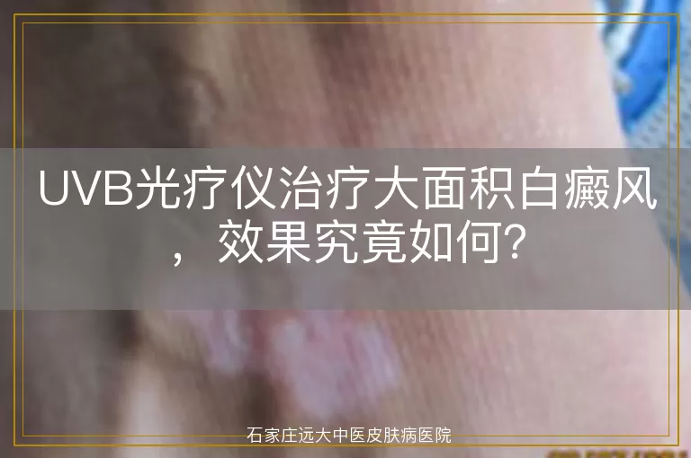 UVB光疗仪治疗大面积白癜风，效果究竟如何？
