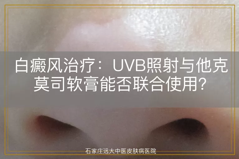 白癜风治疗：UVB照射与他克莫司软膏能否联合使用？