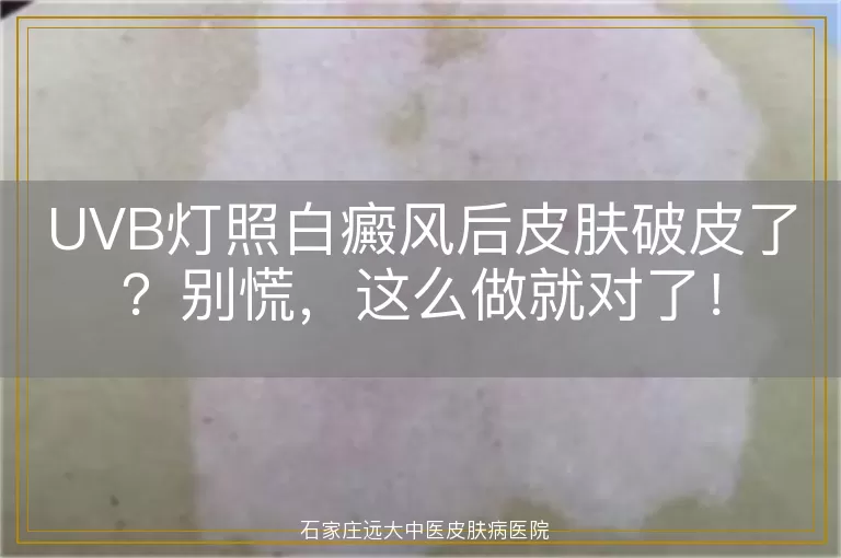 UVB灯照白癜风后皮肤破皮了？别慌，这么做就对了！