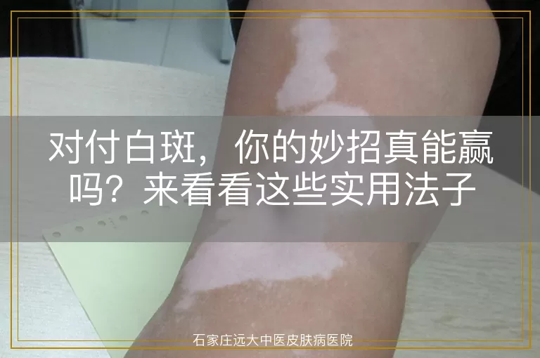 对付白斑，你的妙招真能赢吗？来看看这些实用法子