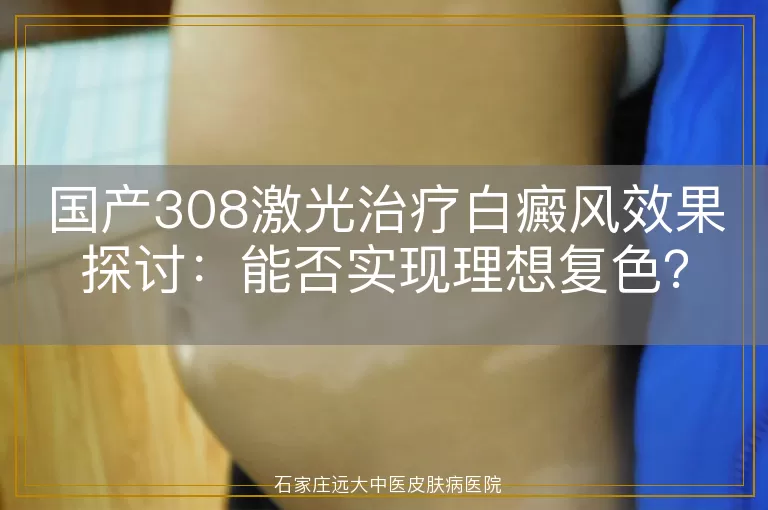 国产308激光治疗白癜风效果探讨：能否实现理想复色？