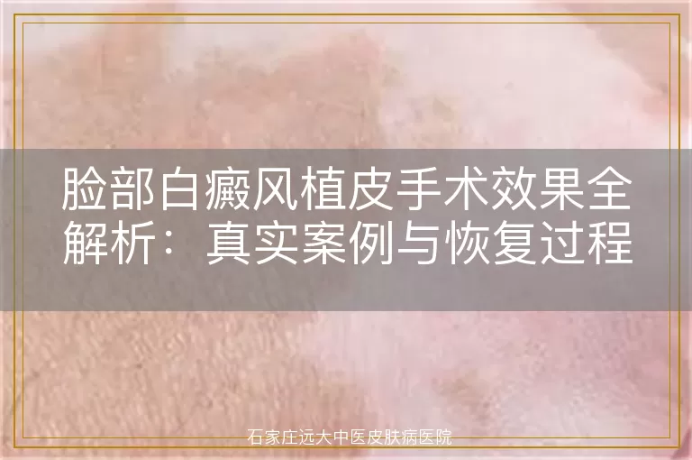 脸部白癜风植皮手术效果全解析：真实案例与恢复过程揭秘